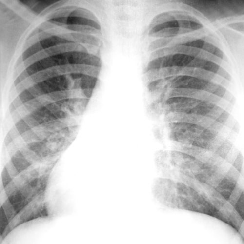 Los pulmones lesionados se pueden regenerar para el trasplante, según un estudio los pulmones lesionados se pueden regenerar para el trasplante, según un estudio Los pulmones lesionados se pueden regenerar para el trasplante, según un estudio plumones cuidado pulmonar 500x500