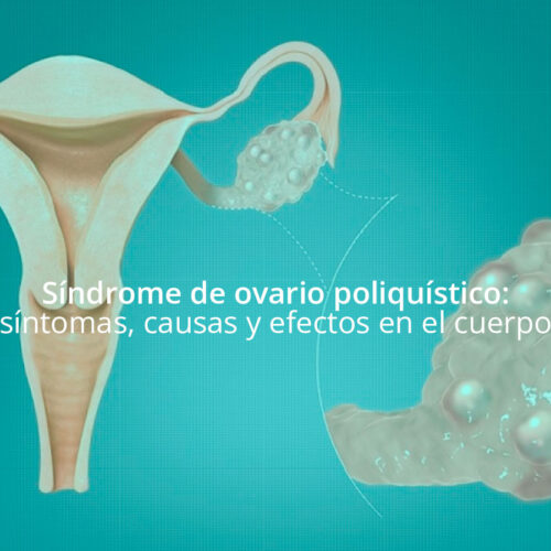 Síndrome de ovario poliquístico: síntomas, causas y efectos en el cuerpo  Síndrome de ovario poliquístico: síntomas, causas y efectos en el cuerpo ovario poliquistico 500x500